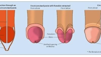 circumcision before and after circumcision before and after